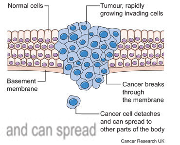 cancer spread2
